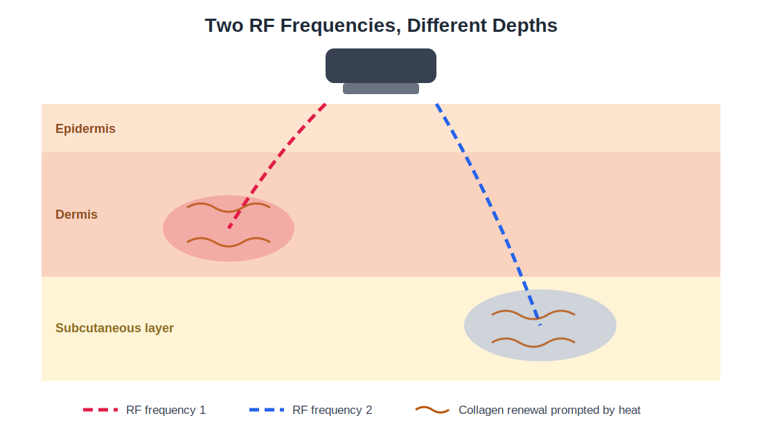 Cross-section of skin showing the epidermis, dermis and subcutaneous layer. A handpiece on the surface sends two radiofrequency paths to different depths: one heats an area in the dermis and the other heats an area in the subcutaneous layer, and wavy lines in both heated areas show collagen renewal prompted by the heat.