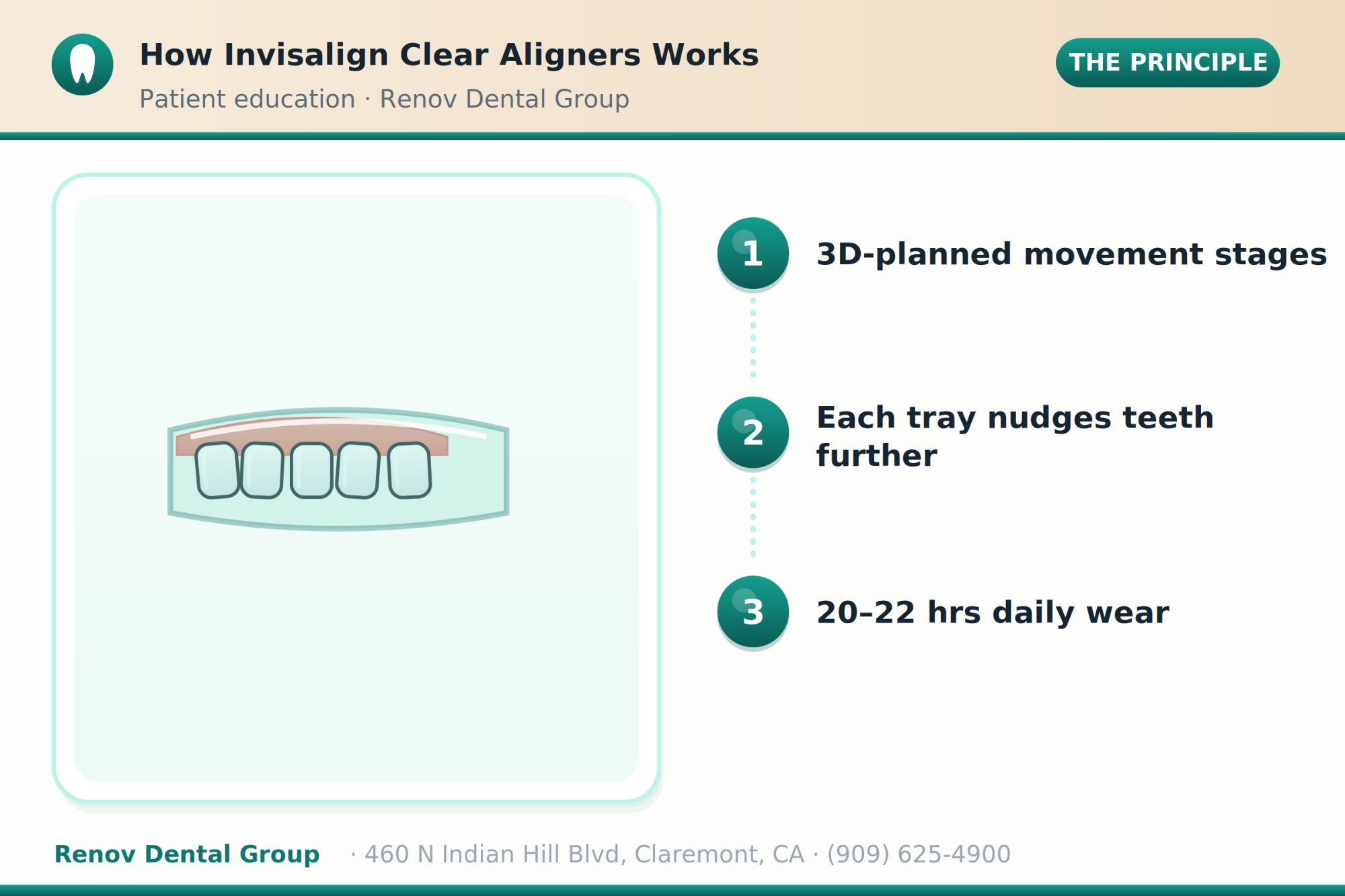 invisalign 01 how it works