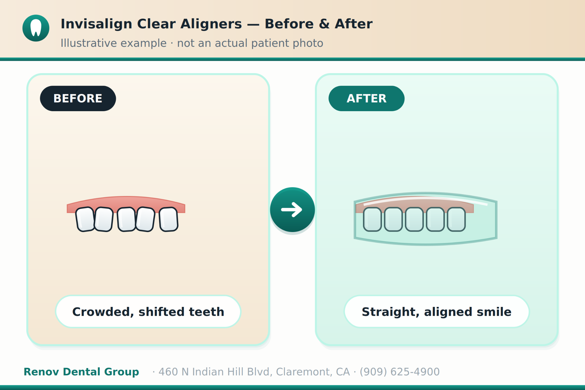 invisalign 03 before after illustration