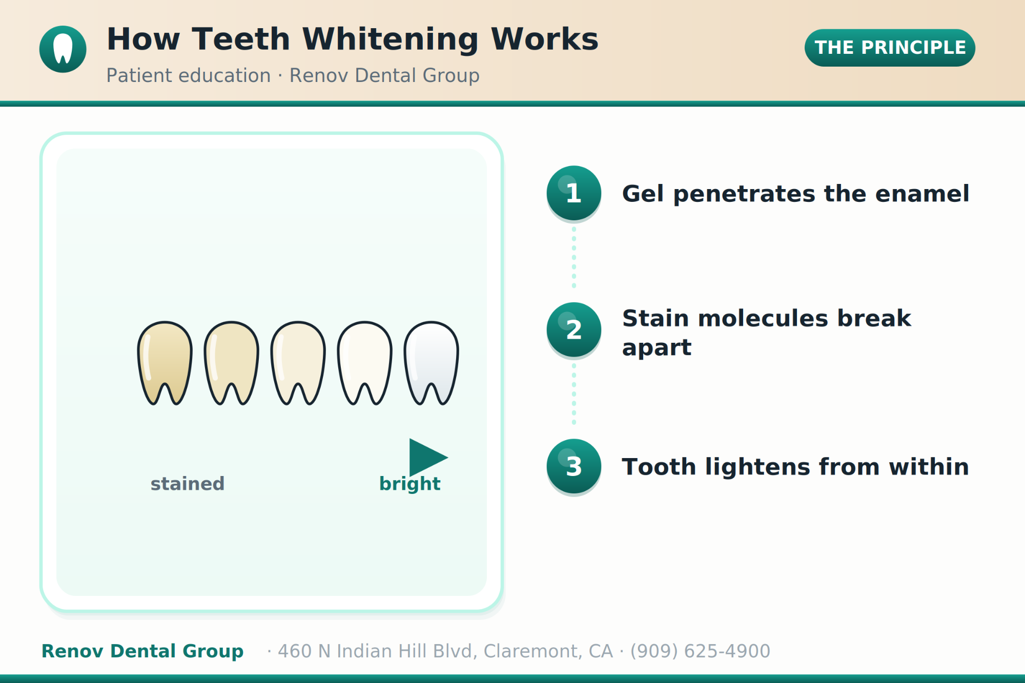 teeth whitening 01 how it works