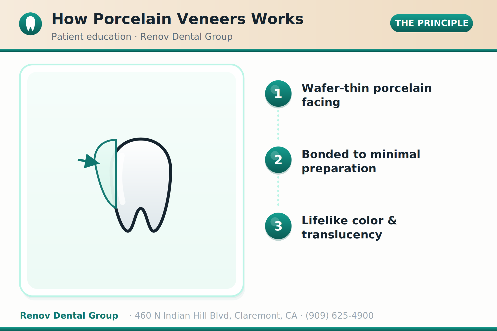 veneers 01 how it works