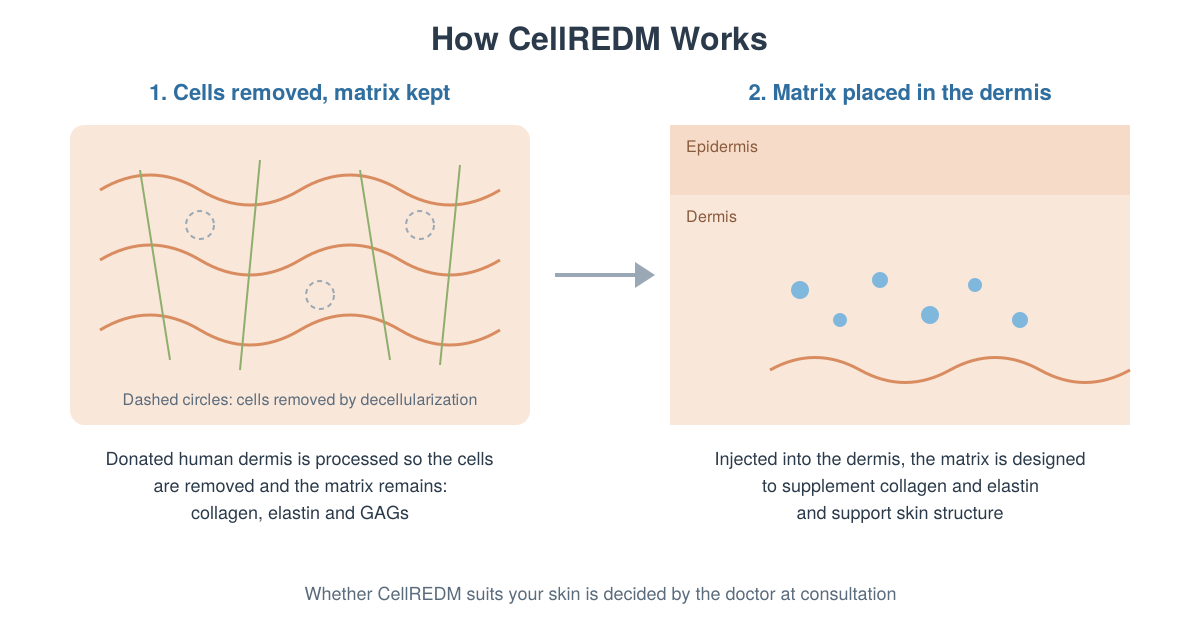 Two panels. On the left, labelled Cells removed, matrix kept, wavy orange collagen lines and straight green elastin lines form a mesh, with dashed circles marking where cells were removed by decellularization; the caption says donated human dermis is processed so the cells are removed and the matrix of collagen, elastin and GAGs remains. An arrow points to the right panel, labelled Matrix placed in the dermis, which shows skin layers with small blue particles in the dermis; the caption says the matrix, injected into the dermis, is designed to supplement collagen and elastin and support skin structure. A note below says the doctor decides at consultation whether CellREDM suits your skin.