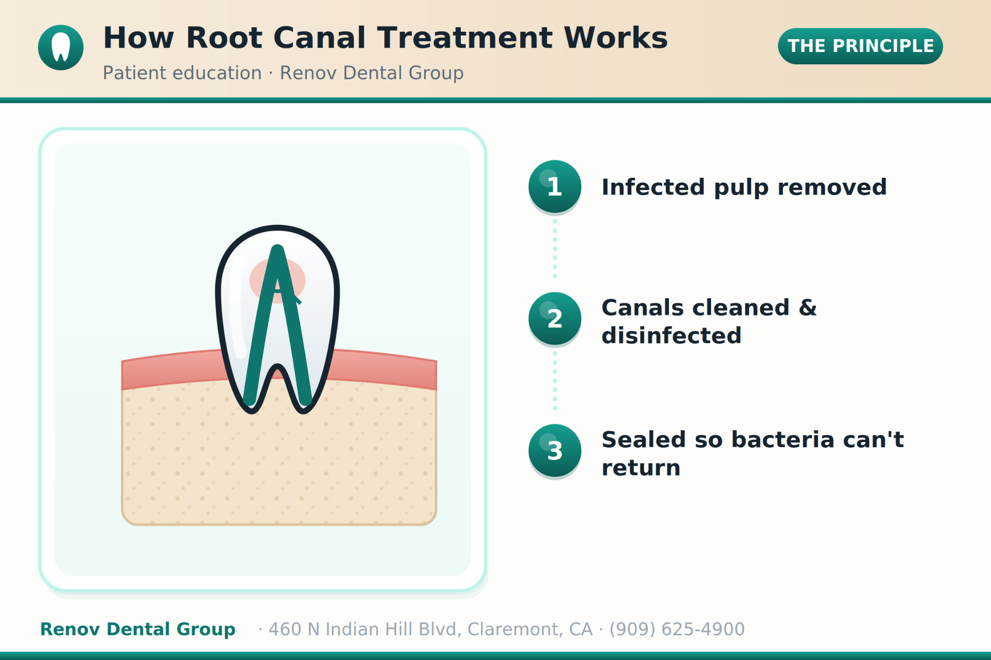 root canal 01 how it works