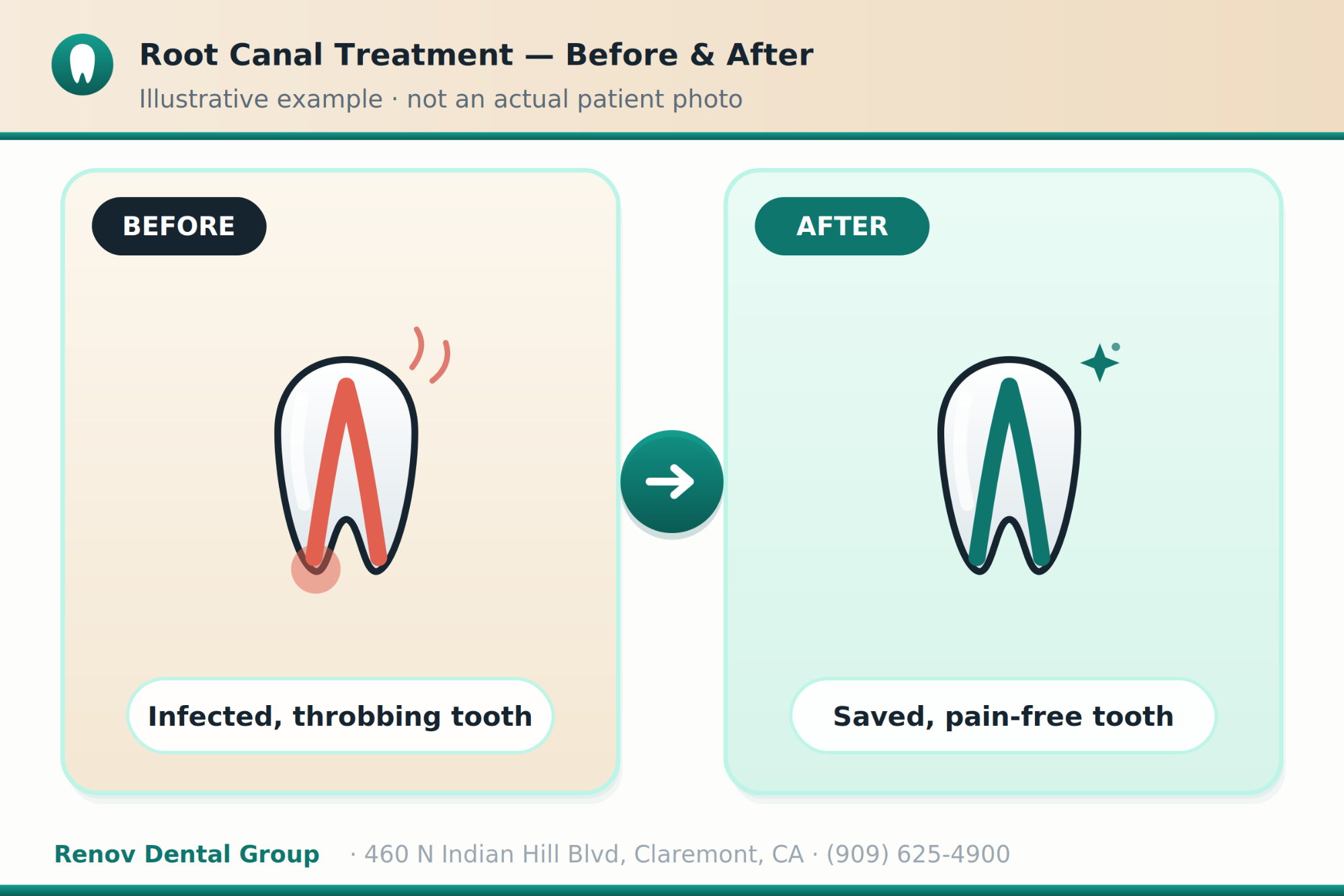 root canal 03 before after illustration