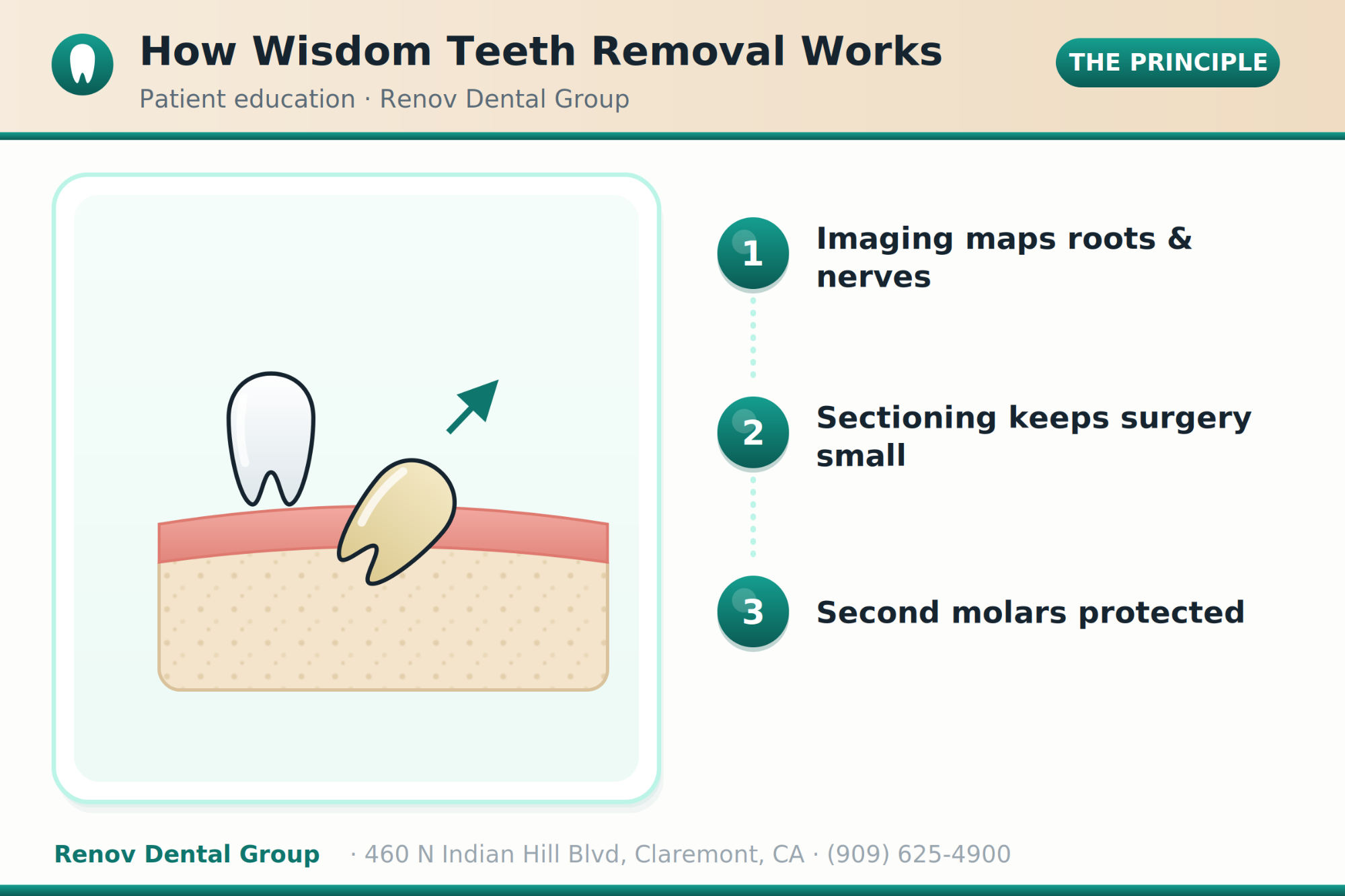 wisdom teeth removal 01 how it works