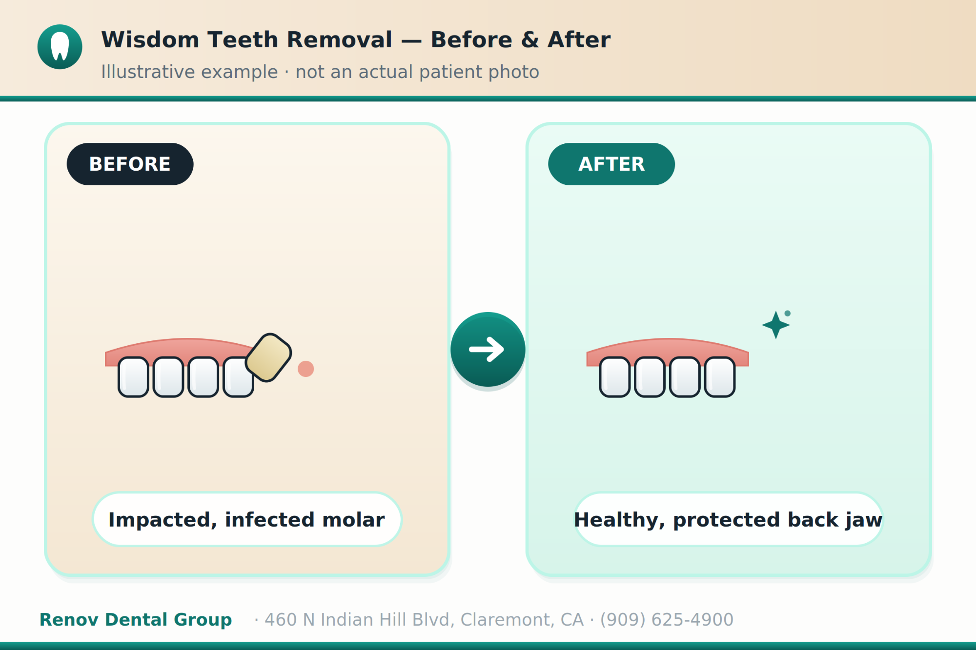 wisdom teeth removal 03 before after illustration
