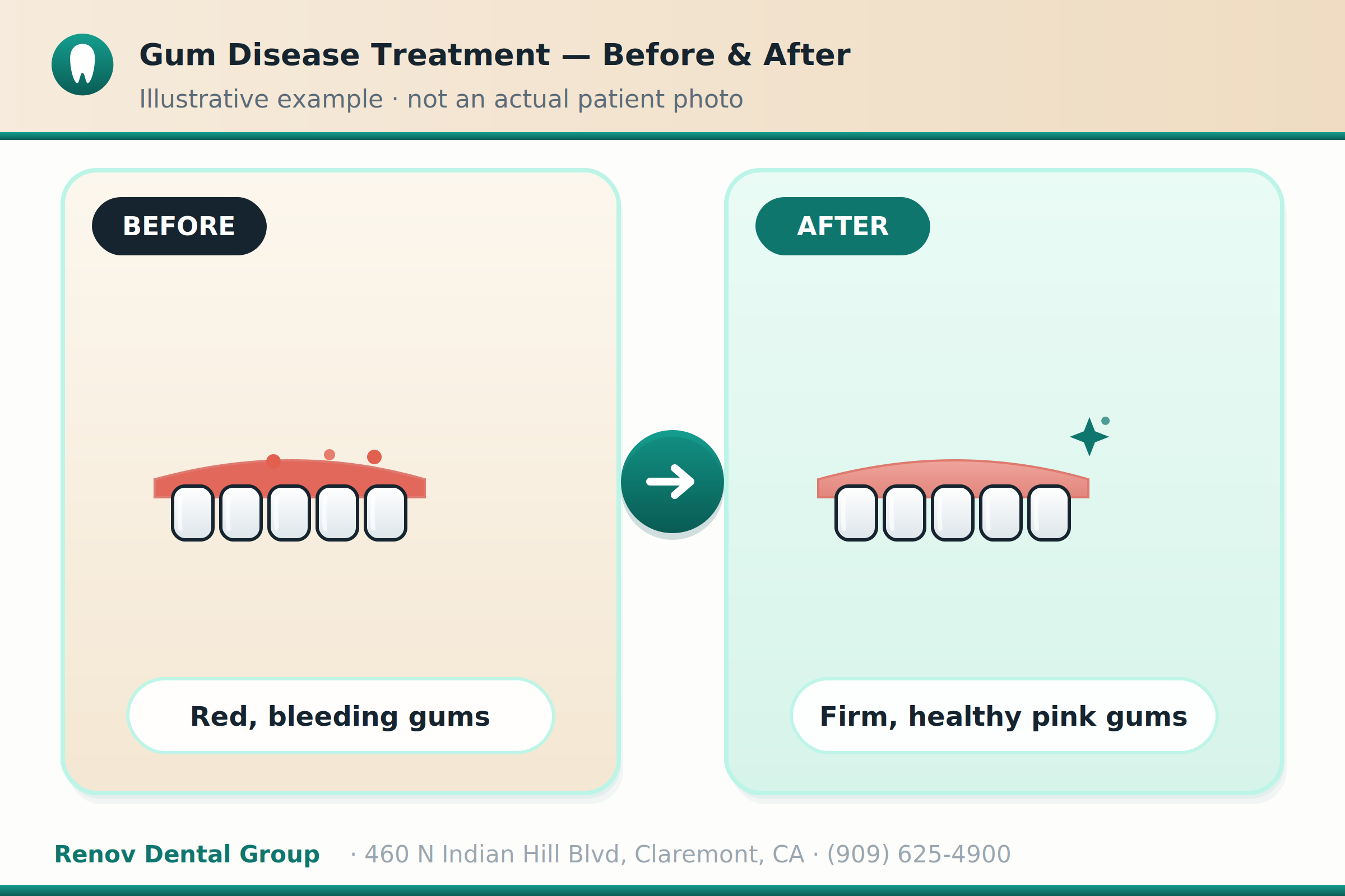 Gum Disease Treatment in Claremont, CA 3