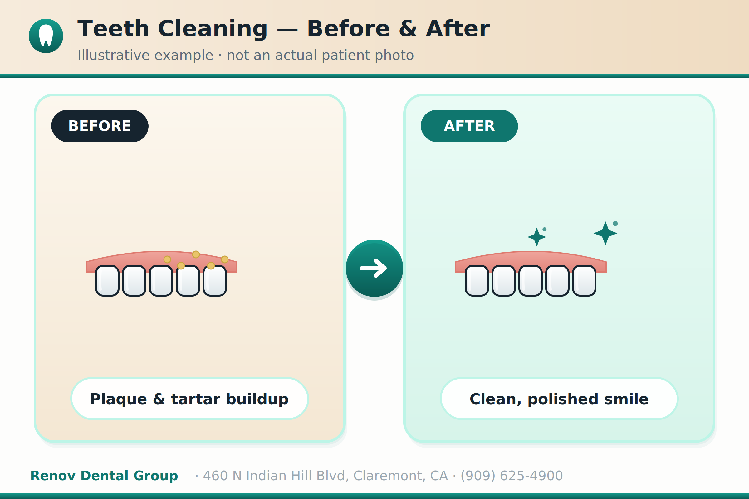 Teeth Cleaning in Claremont, CA