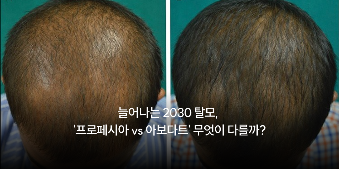 Hair loss in your twenties and thirties: finasteride or dutasteride?