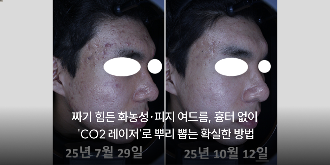 Pustular, sebum-packed acne: CO2 laser without scarring