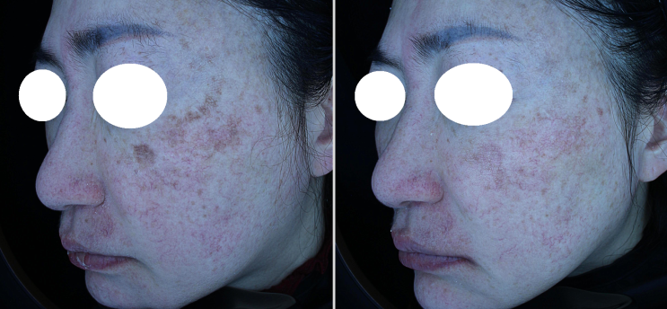 Treating stubborn melasma: consistency over flawless skin