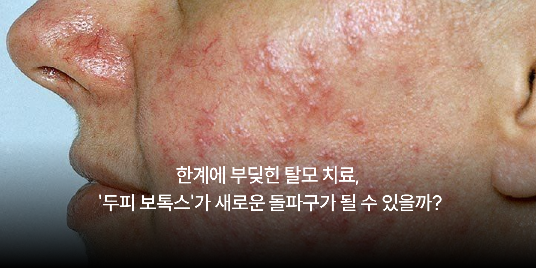 Deepening facial redness — could it be rosacea?