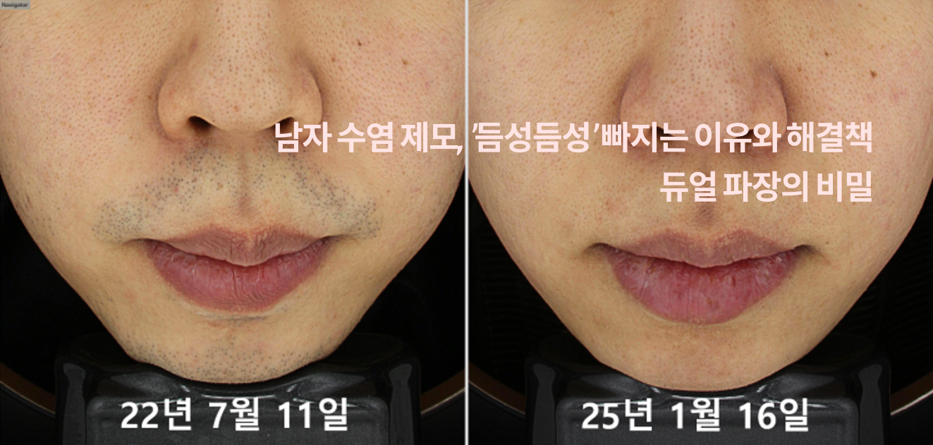 Men's beard removal: why hair clears patchily