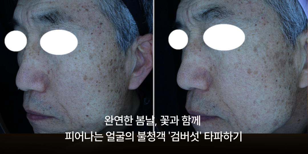 Age spots in spring: dealing with seborrheic keratosis