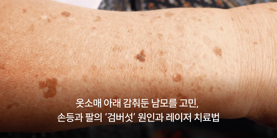 Age spots on the hands and arms: causes and laser treatment