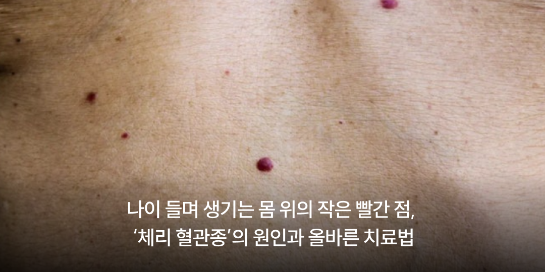 Small red dots on the body with age: cherry angioma explained