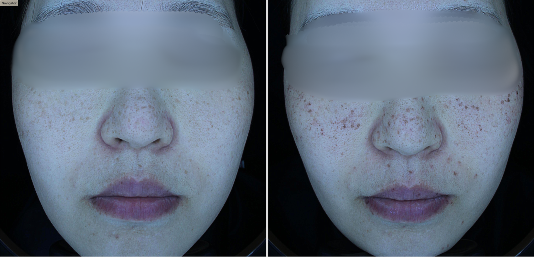 Freckles and epidermal pigment: the nBOM Lentigo Package
