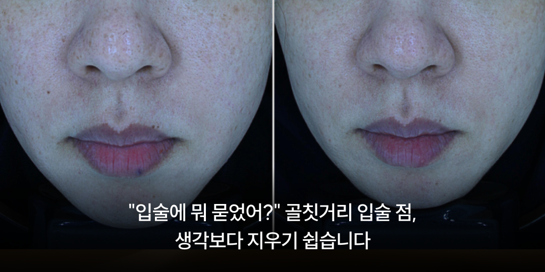 Lip spots are easier to remove than you think