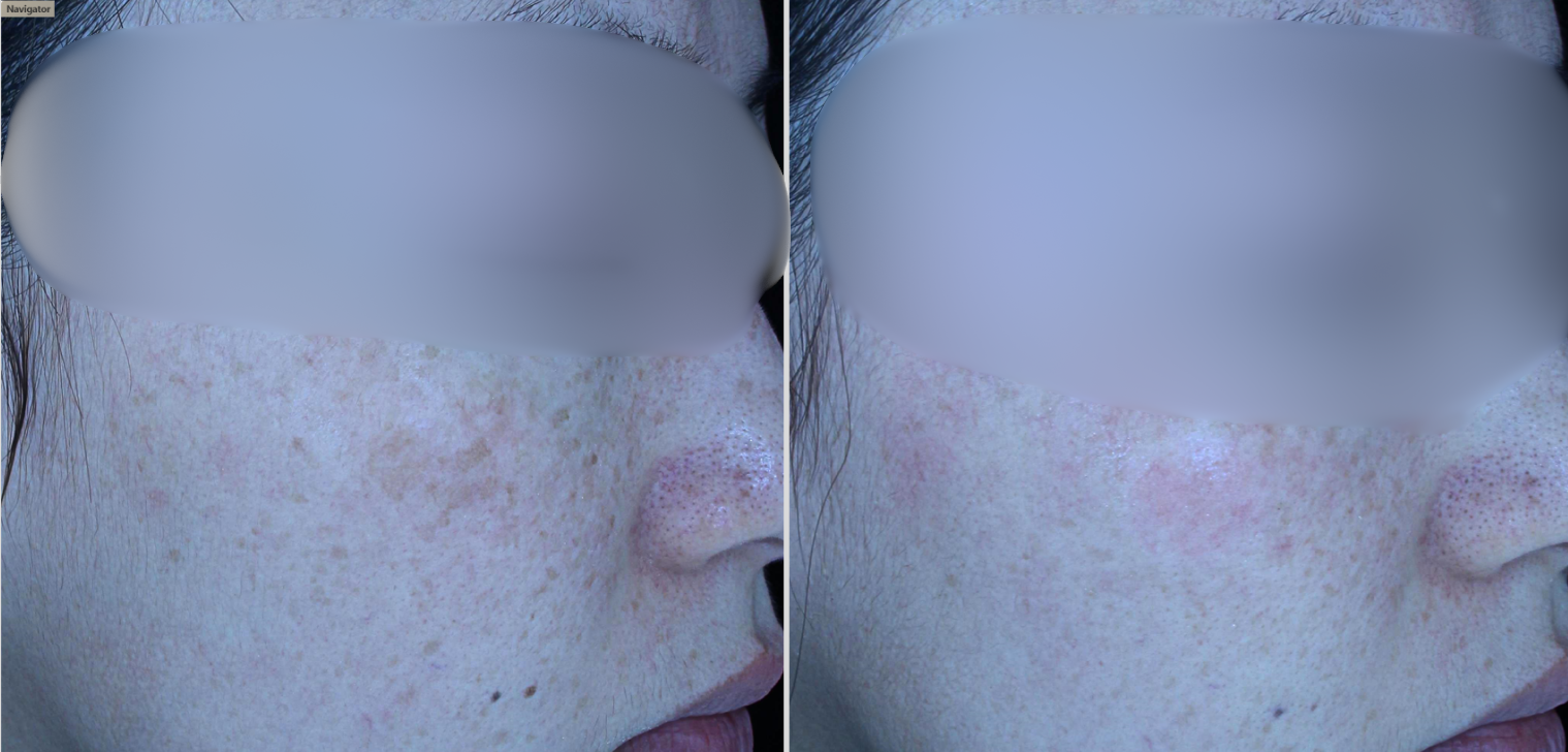 Sylfirm X: needle RF for refractory melasma
