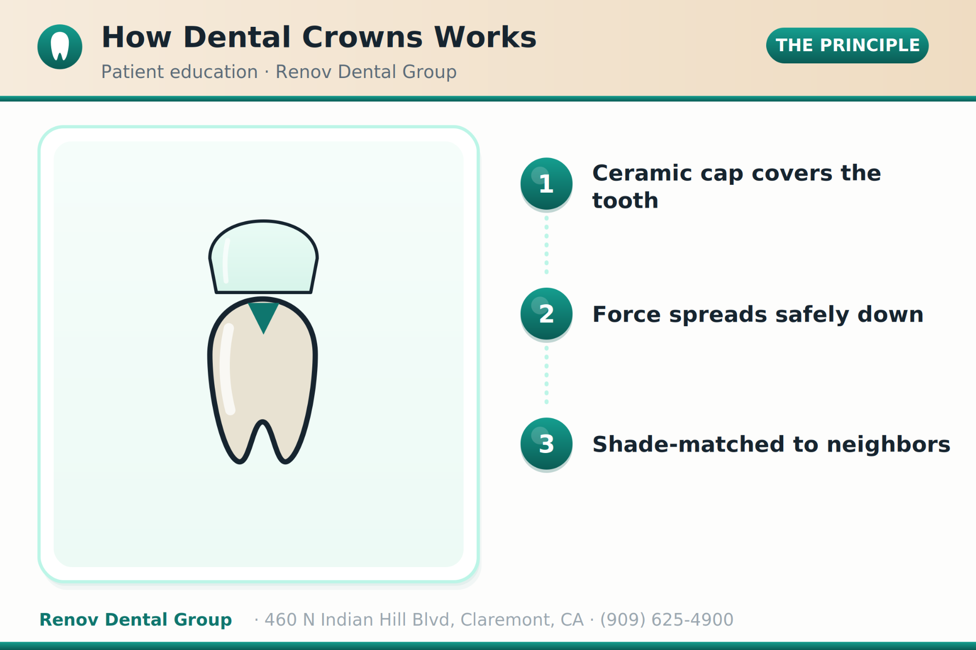 dental crowns 01 how it works