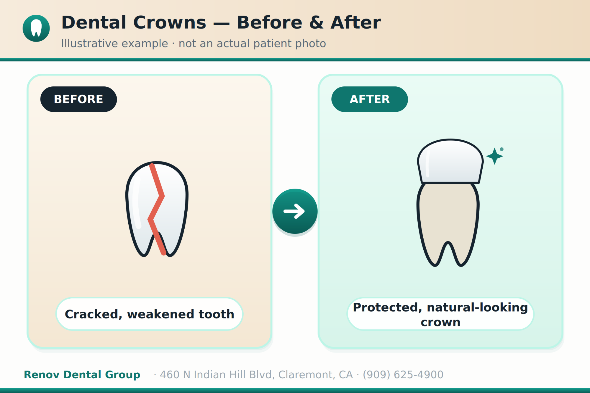 dental crowns 03 before after illustration