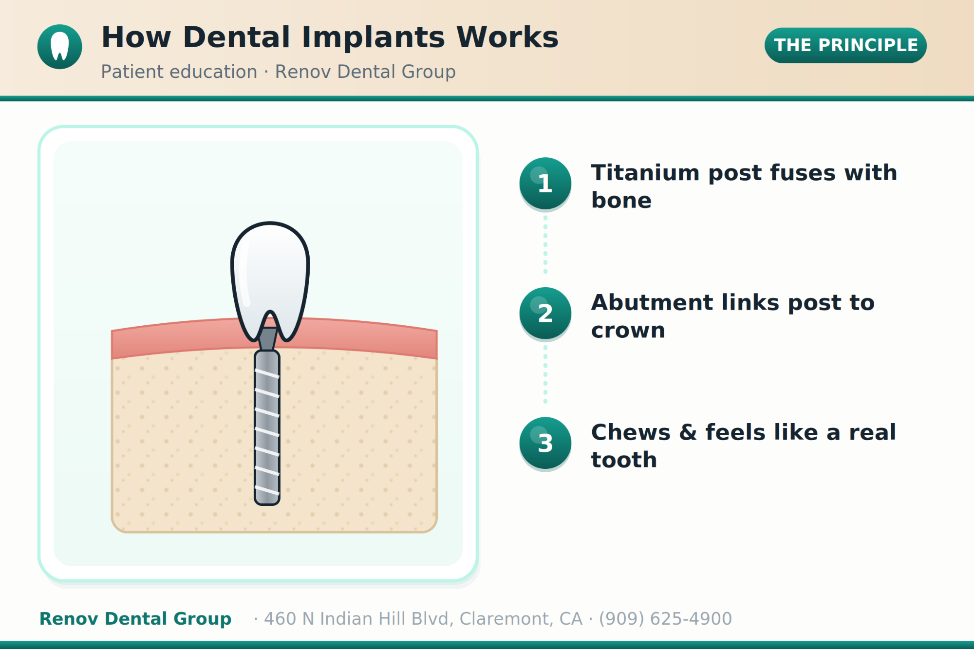 dental implants 01 how it works