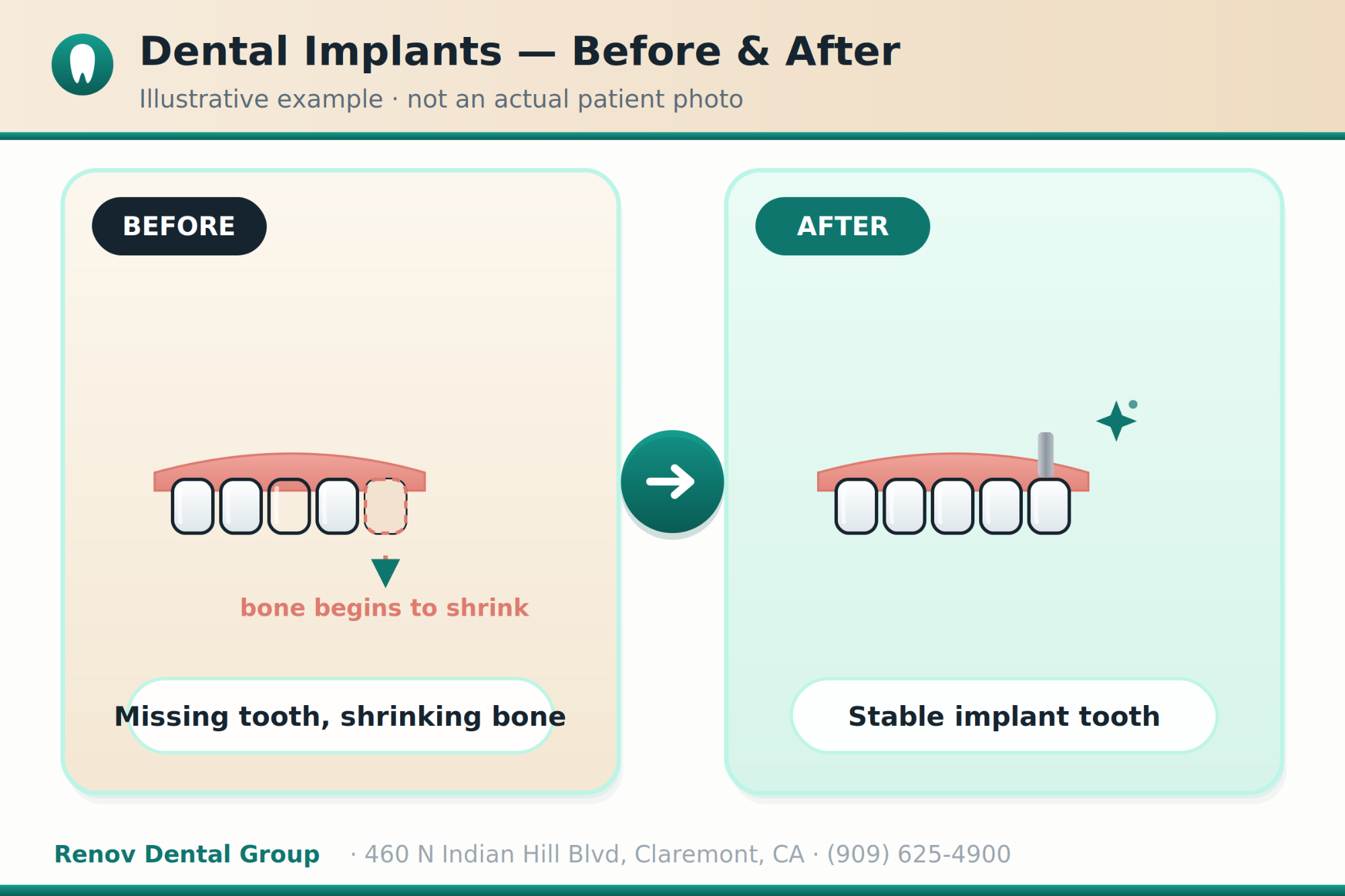 dental implants 03 before after illustration